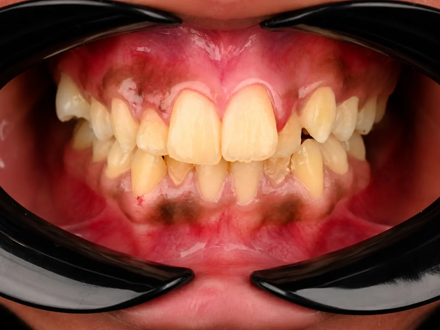 Pre-treatment frontal intraoral view showing anterior crowding and rotations