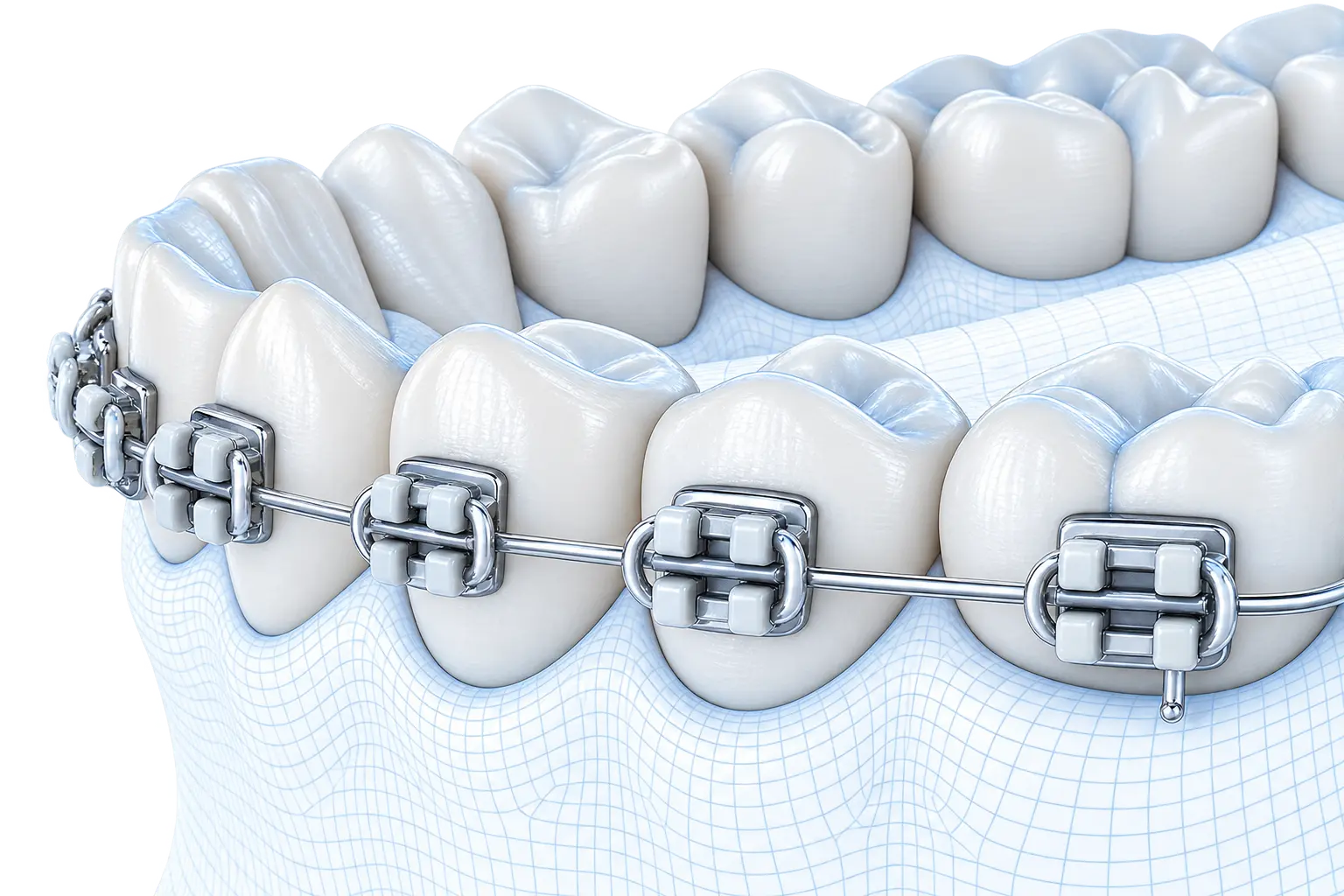 Metal fixed appliance on a digitally modelled lower arch