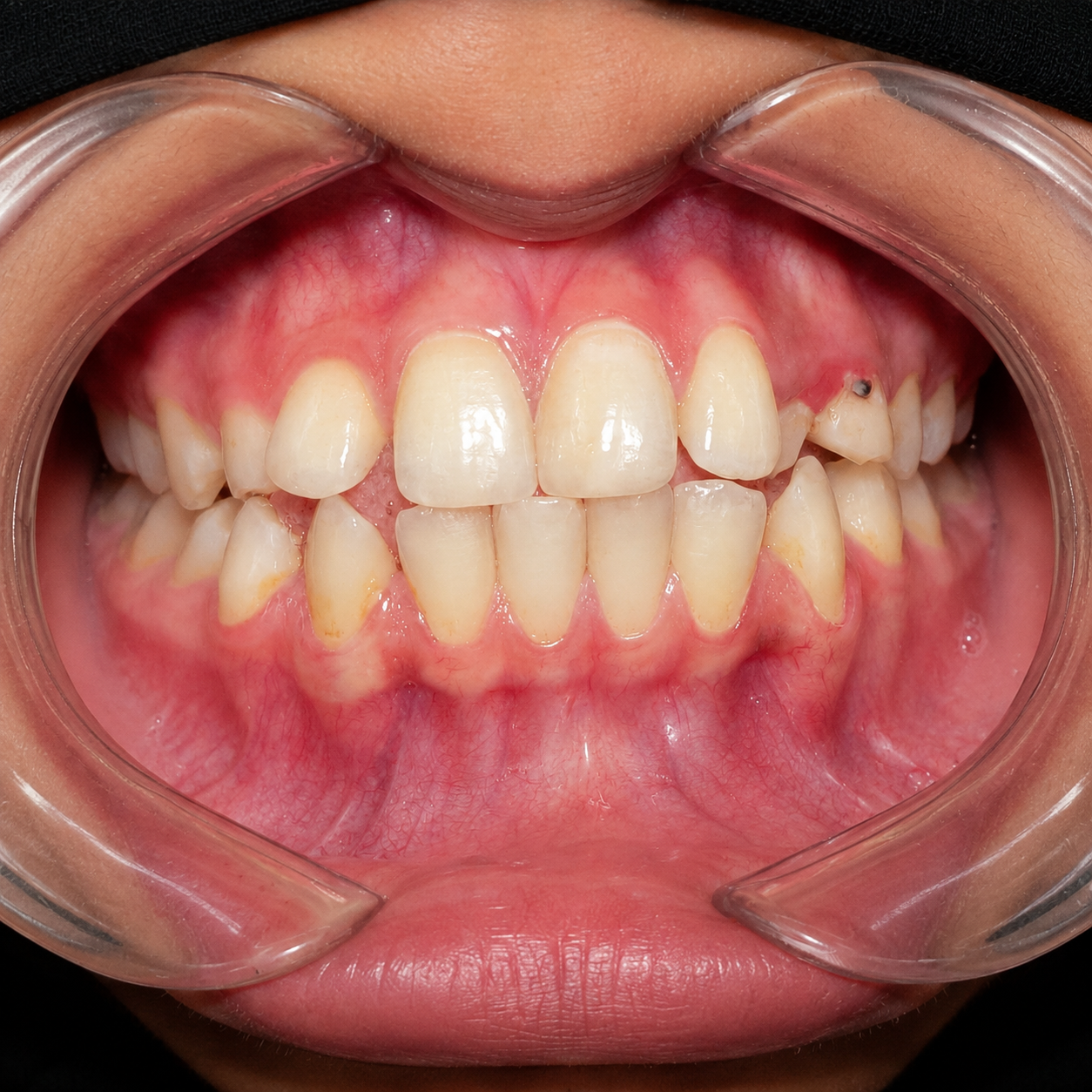 Pre-treatment frontal intraoral view showing severe crowding and a blocked-out upper canine