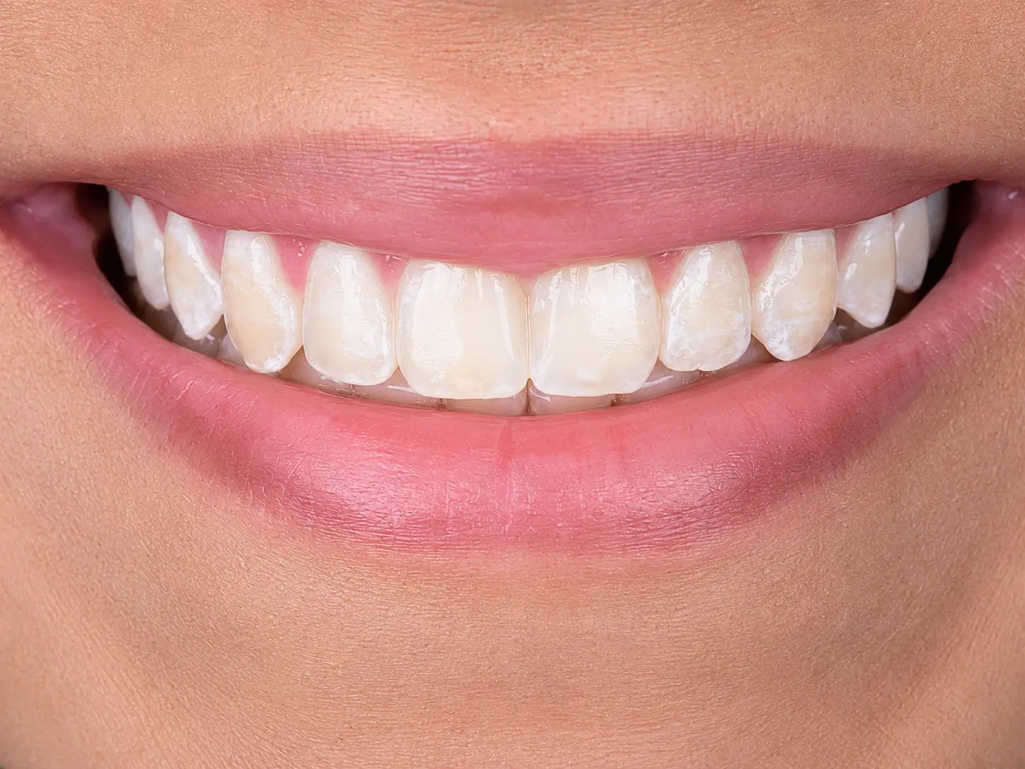 Post-treatment smile view with an even incisal plane