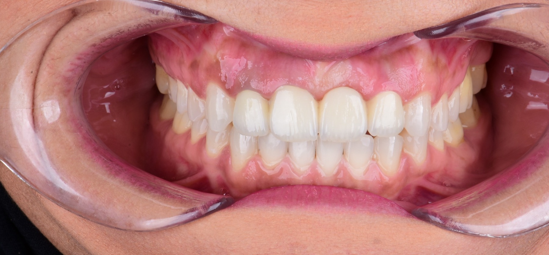 Post-treatment frontal intraoral view with redistributed space and level incisal plane