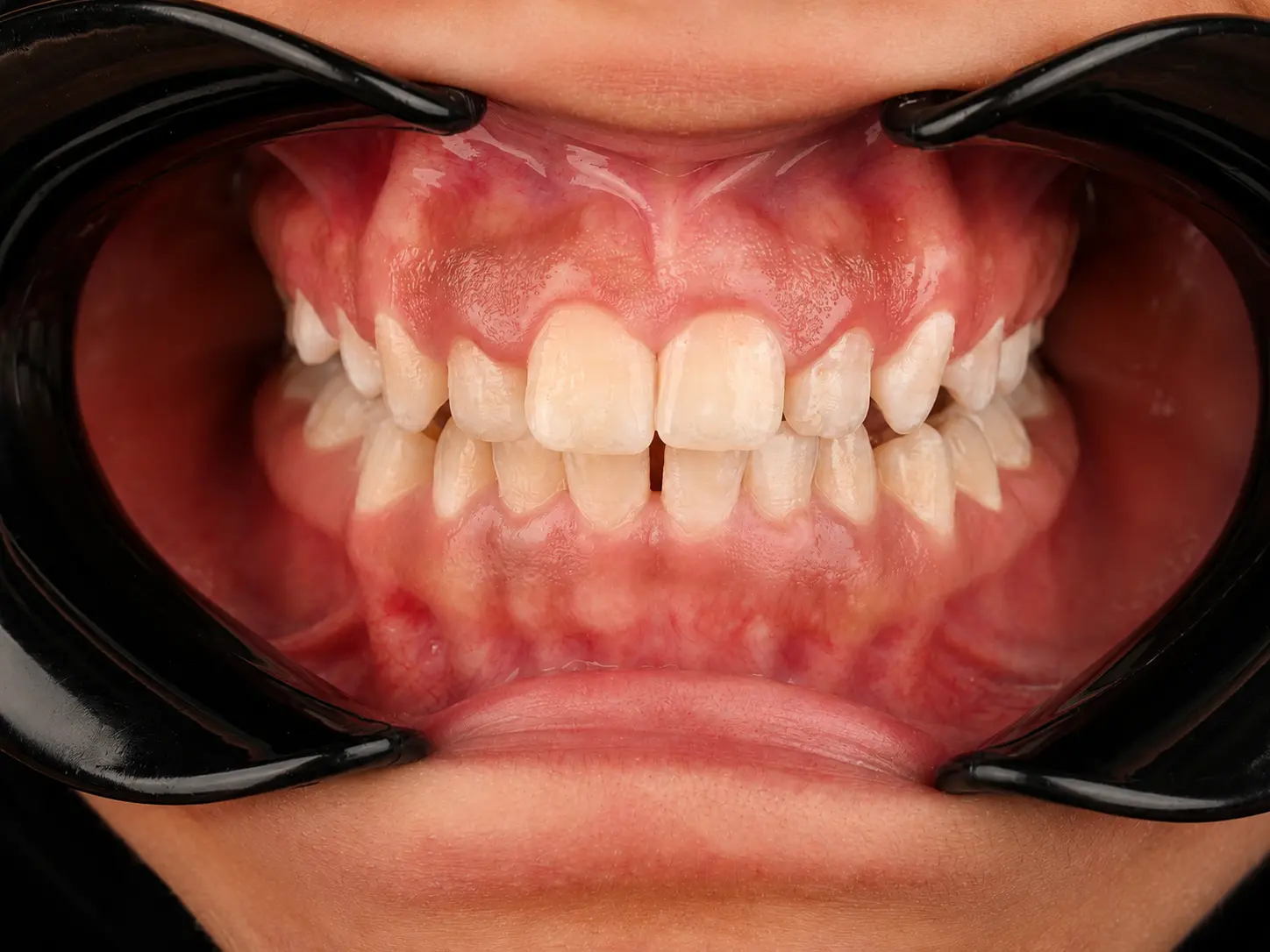 Pre-treatment frontal intraoral view showing crowding and an edge-to-edge anterior relationship