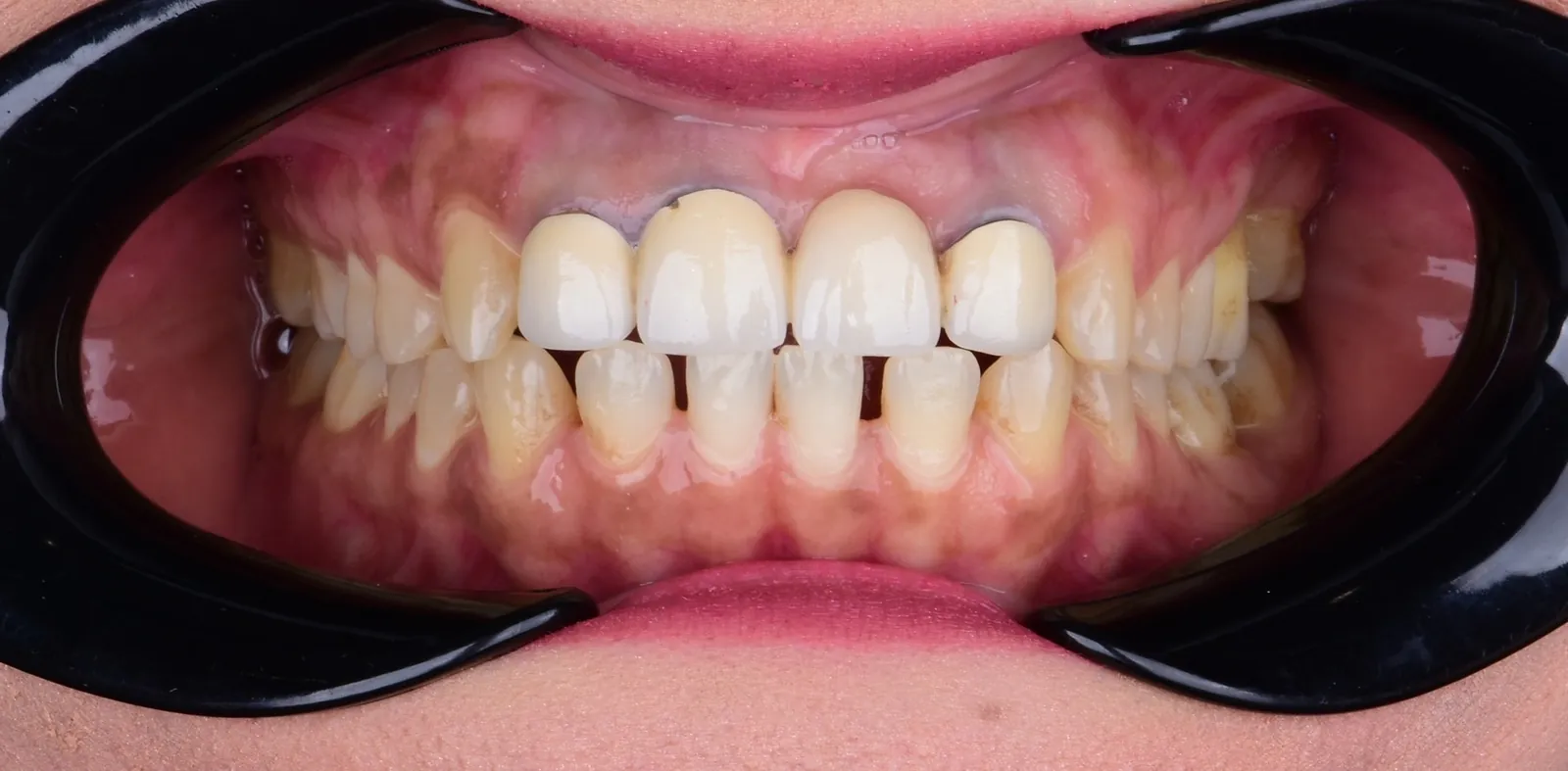 Pre-treatment frontal intraoral view showing anterior spacing and mismatched restorations