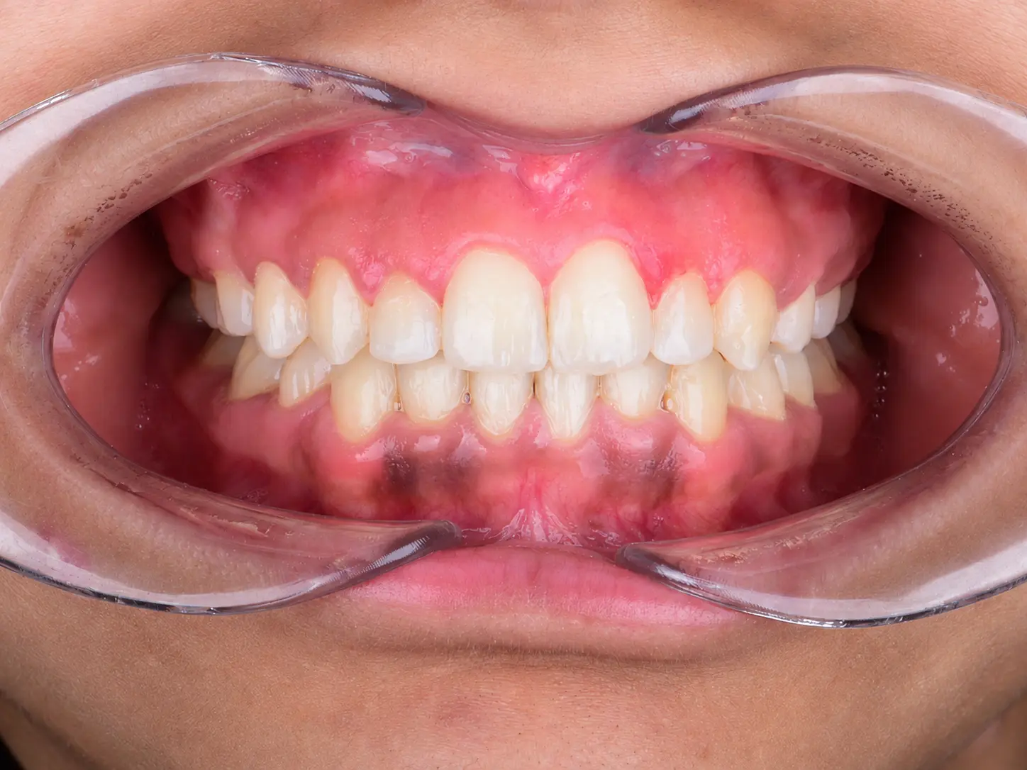 Post-treatment frontal intraoral view with aligned anterior segments