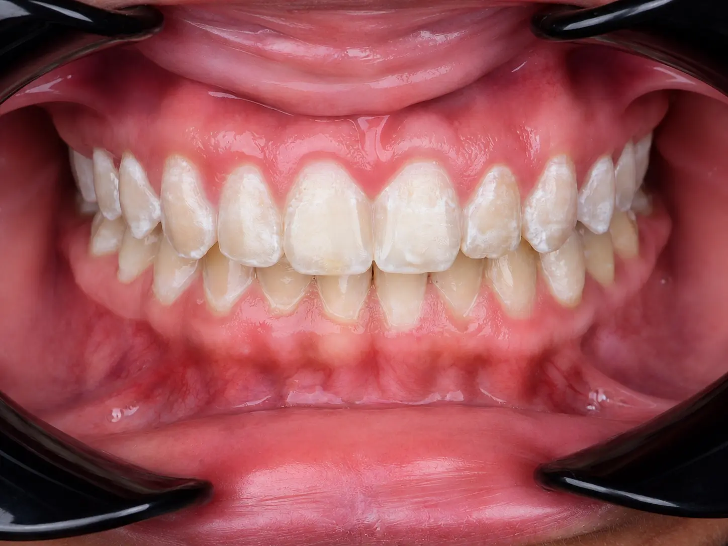 Post-treatment frontal intraoral view with aligned arches and distributed anterior contact