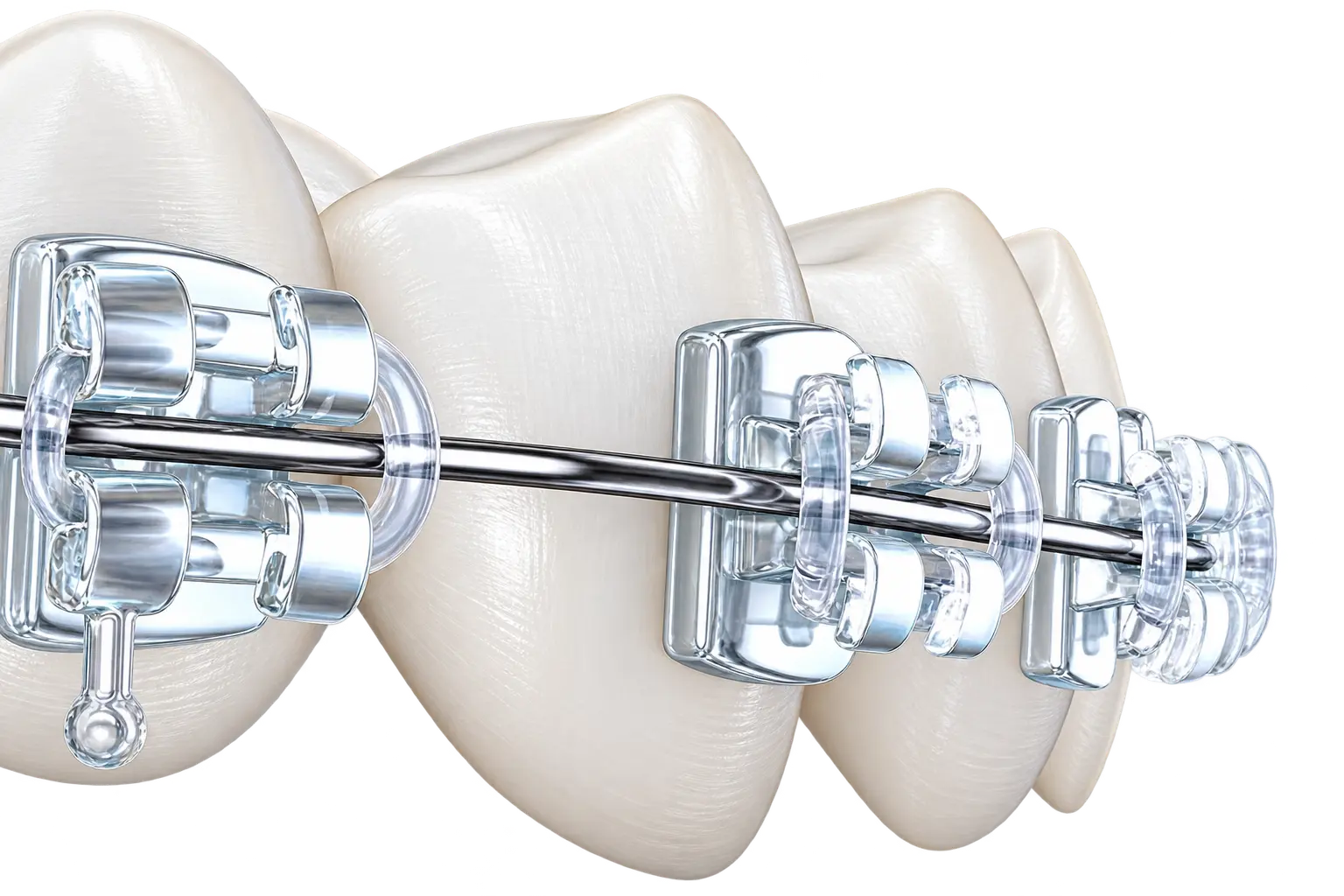 Ceramic aesthetic brackets with clear ligatures on a close-up arch