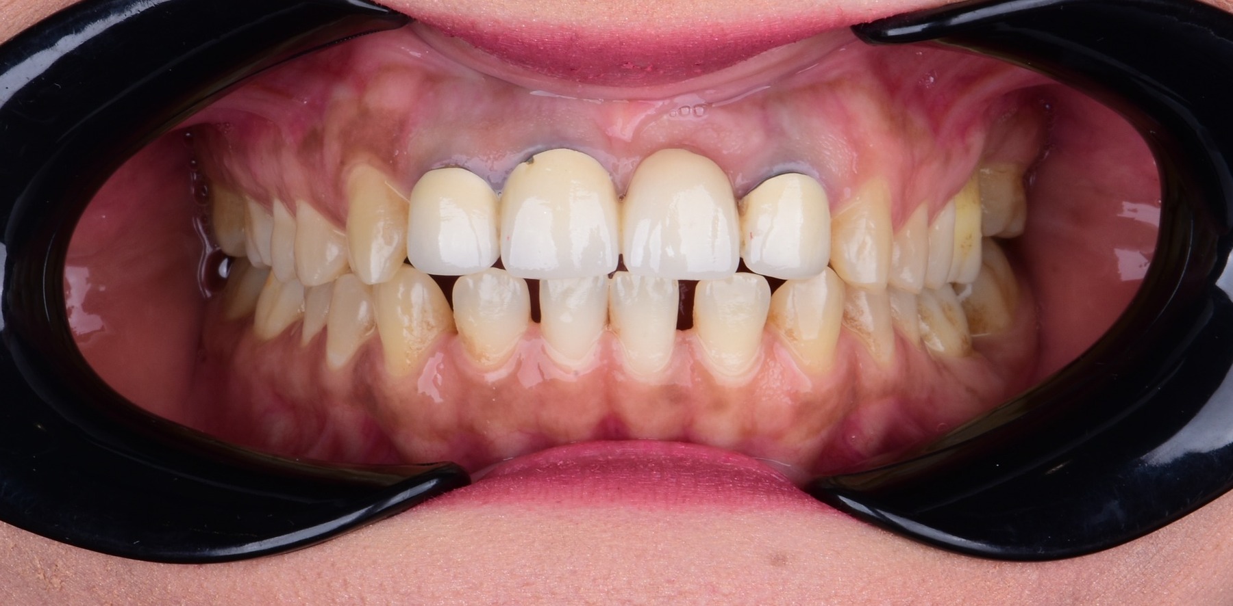 Pre-treatment frontal intraoral view showing anterior spacing and mismatched restorations
