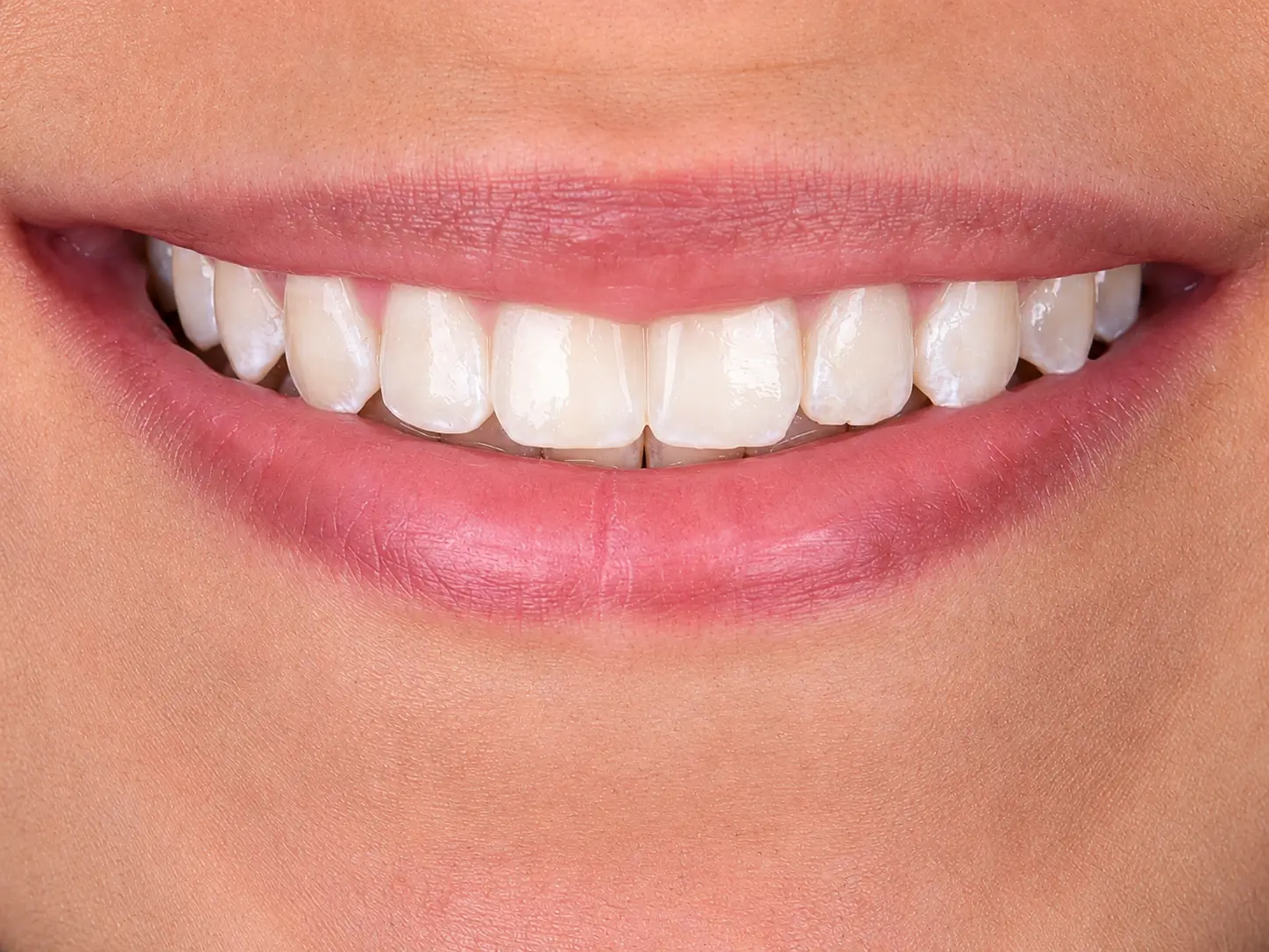 Post-treatment close smile view showing balanced tooth proportion