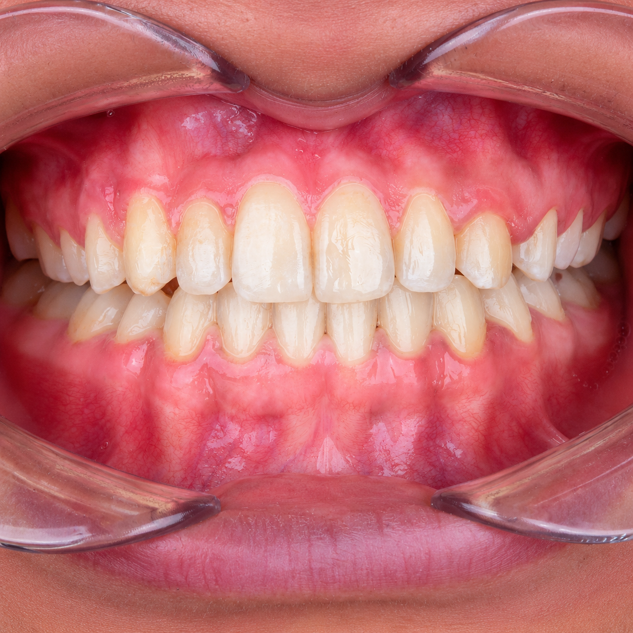 Post-treatment frontal intraoral view with aligned arches and a level incisal plane